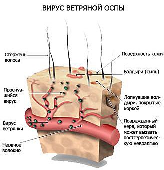 Ветрянка у взрослых фото форум