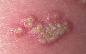 Герпес на фото